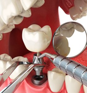 tratamiento implantes dentales zaragoza