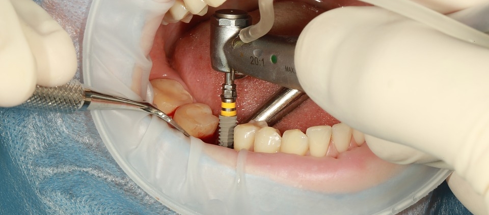 implantes dentales cuidados