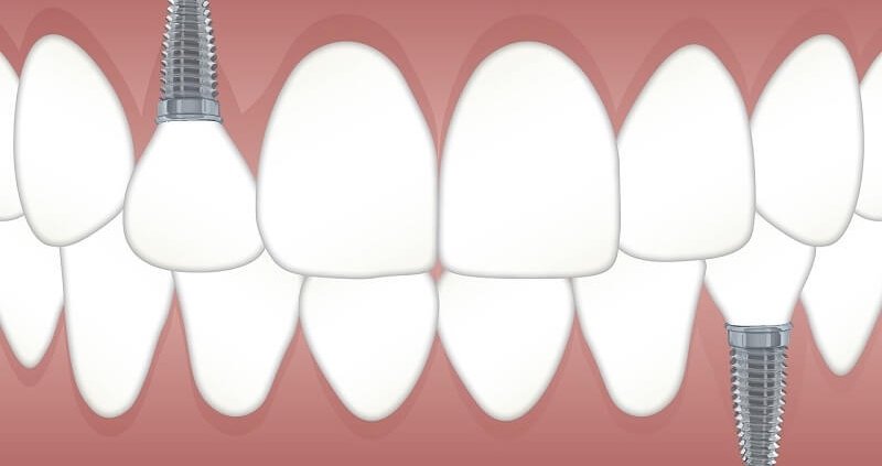 diferencia puente implante dental