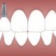 diferencia puente implante dental