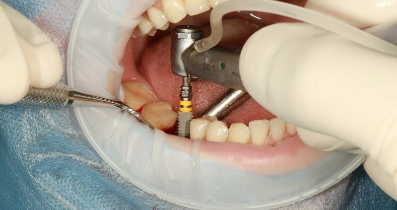 material implantes dentales