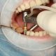 material implantes dentales