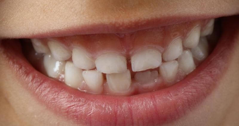 caries infantil causas tratamiento