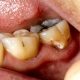 agujeros dientes muelas